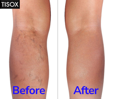 TISOX Help varicose veins